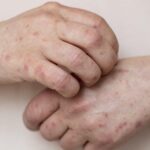 piel reseca, ronchas de resequedad, manos resecas, fisiogel, fisiogel hipoalergenico, fisiogel cuidado hidratante, crema liquida, fisiogel piel seca, fisiogel para piel sensible, fisiogel crema liquida